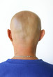 baldness