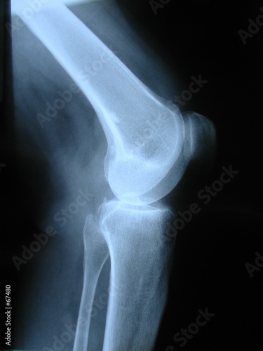 broken leg x ray. x-ray
