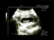 echographie