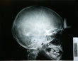 Photo: x-ray of my younger brother head x-ray of my younger brother head