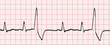 électrocardiogramme