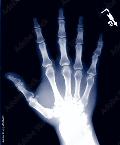 X Ray Hand. normal hand x-ray