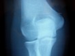 x-ray of elbow