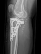 knee fracture