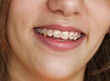 smile with braces