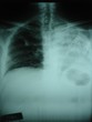 big pleural effusion