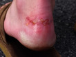 blister buster!