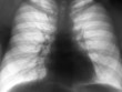 xray chest negative