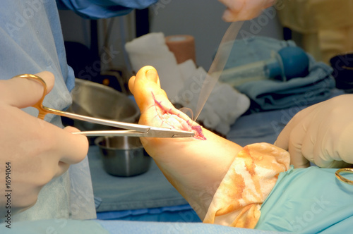 Photo: foot surgery - bunionectomy - suturing foot surgery - bunionectomy - suturing