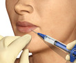lip enhancement