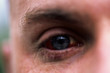 barotrauma diving injury