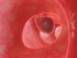 darm polyp