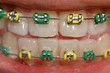 colorful brace