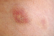 skin welt