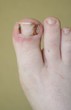toenail