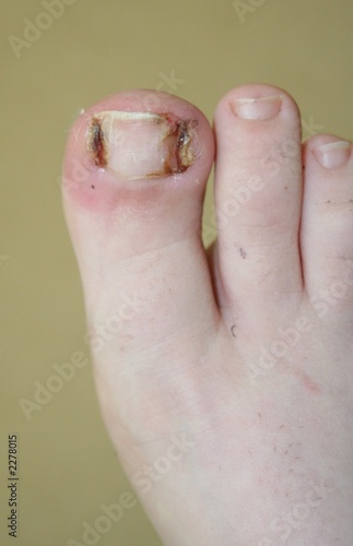Photo: toenail toenail
