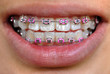 Photo en ligne au meilleur prix colorful braces