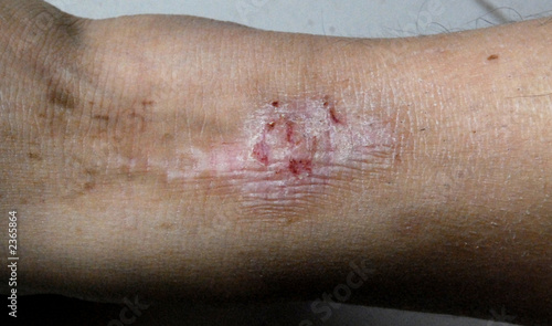 Photo: eczema eczema