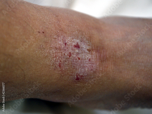 Photo: eczema eczema