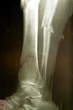 limb fracture