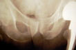 hip xray