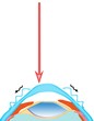 laser assisted intra-stromal keratomileusis