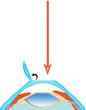 laser assisted sub-epithelial keratomileusis laser assisted sub-epithelial keratomileusis