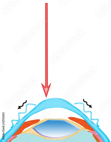 laser assisted intra-stromal keratomileusis laser assisted intra-stromal keratomileusis