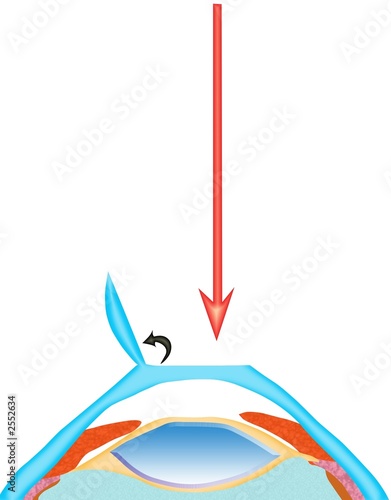 laser assisted sub-epithelial keratomileusis laser assisted sub-epithelial keratomileusis