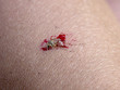 mosquito on my hand. part 7. final