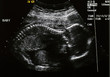 ultrasound