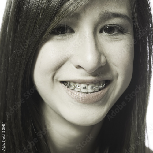 Photo: smiling with dental braces smiling with dental braces