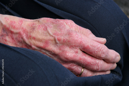 Photo: Sceriosis Sceriosis