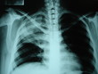 TUBERCULOSIS PULMONAR TUBERCULOSIS PULMONAR