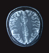 MRI Scan
