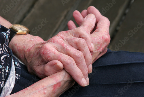 Photo: Sceriosis Skin Disease Sceriosis Skin Disease