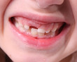 Childs teeth
