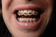Braces