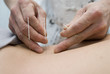 Treatment by acupuncture