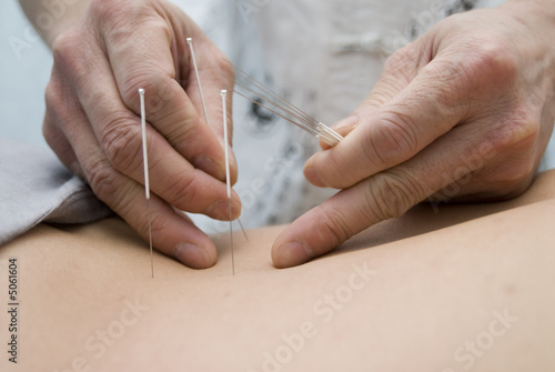 Treatment by acupuncture