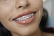 Foto: Teenage Girl 14-16 wearing teeth braces, close-up Teenage Girl 14-16 wearing teeth braces, close-up
