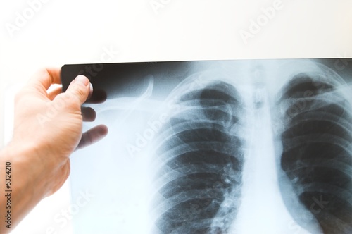 x-ray picture of human chest x-ray picture of human chest