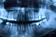 x-ray – panoramic photo of roentgen – jaw, mandible x-ray – panoramic photo of roentgen – jaw, mandible