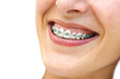 Detail of young womans smile showing white teeth with braces.