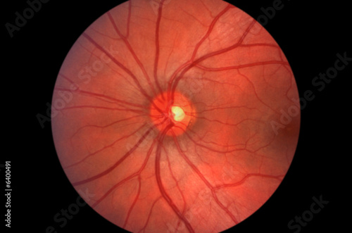 Photo: Retina - Optic Nerve - Human Eye Retina - Optic Nerve - Human Eye