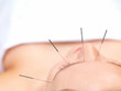 Acupuncture healing beautiful woman