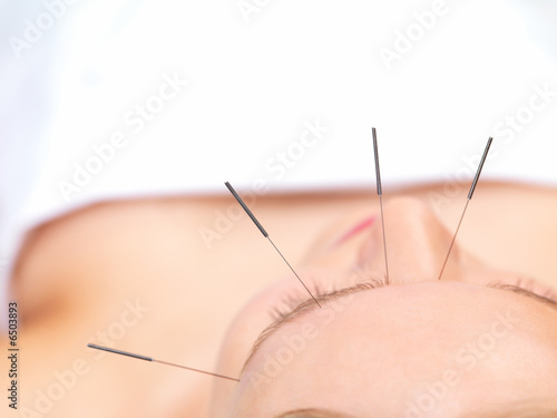 Acupuncture healing beautiful woman
