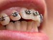 Teeth with retrainer