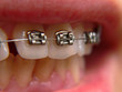 Teeth with retrainer
