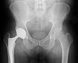 Radiographie Prothèse totale de hanche 